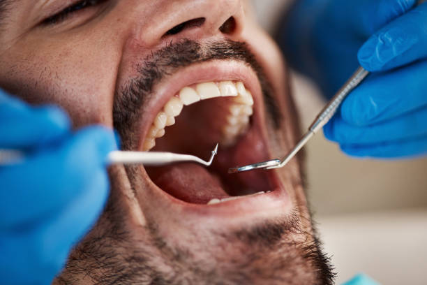 Best Emergency Tooth Extraction in Churchill, OH